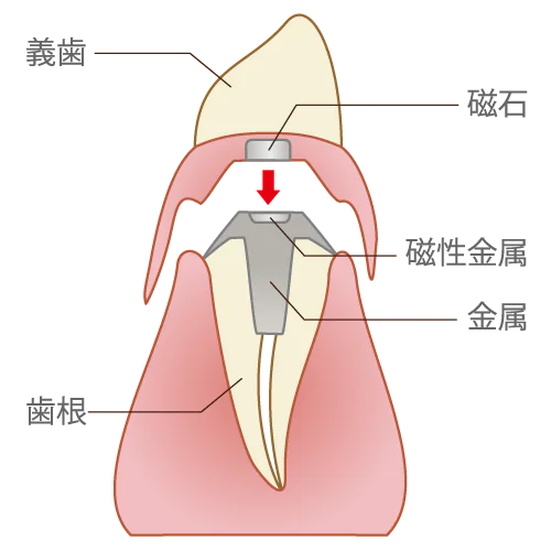 マグネット義歯（保険適用）